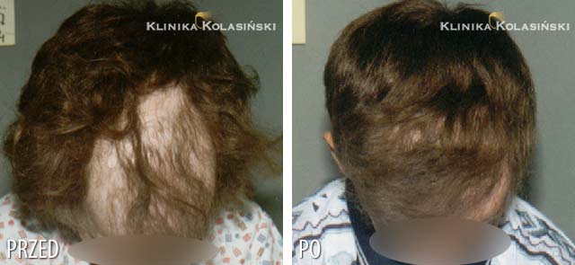Pictures before and after: Kids hair transplant