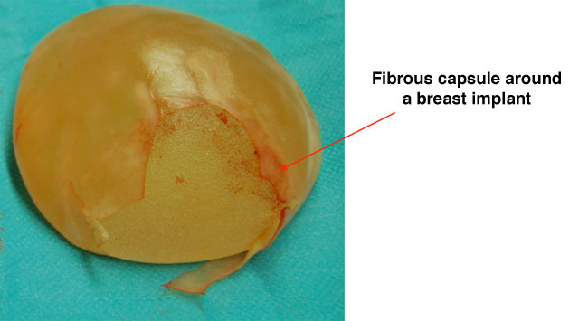 The influence of incision location on the risk of developing a fibrous capsule around a breast implant