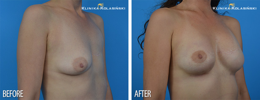 Breast reconstruction- Klinika Kolasiński
