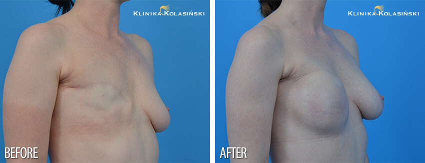 Breast reconstruction- Klinika Kolasiński