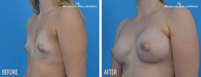 Correction of atypical breasts - Klinika Kolasiński