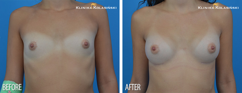Correction of atypical breasts - Klinika Kolasiński