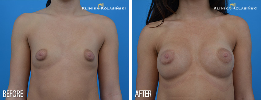 Tubular breasts augmentation - Klinika Kolasiński