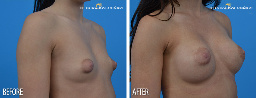 Tubular breasts augmentation - Klinika Kolasiński